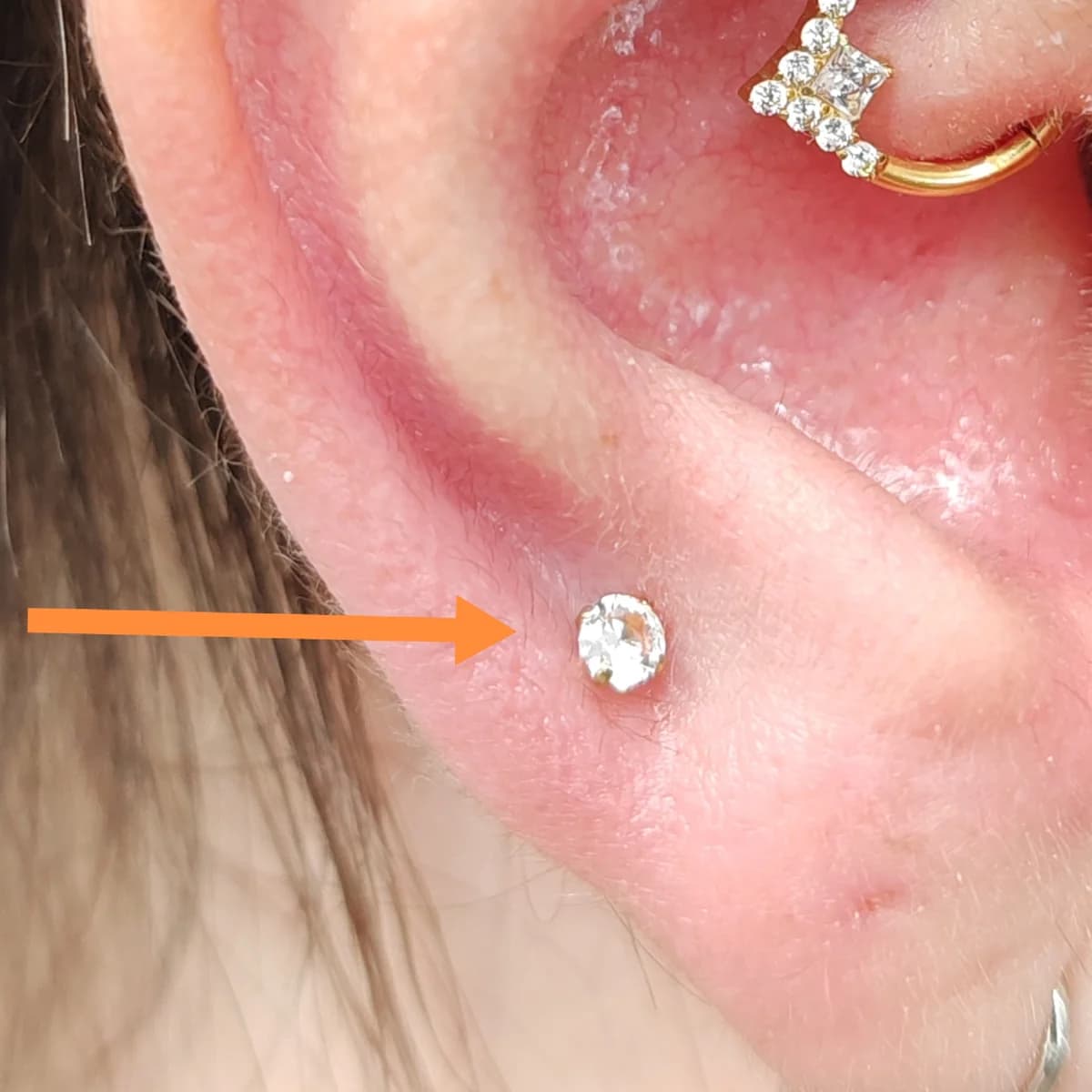 Pajzsmirigy piercing – akupunktúrás piercing titánium ékszerrel